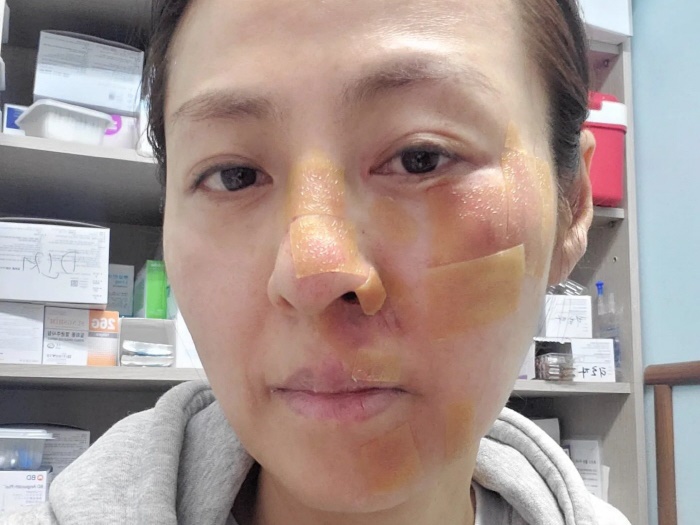 痛々しく腫れあがった顔面…ミスコリア出身女優チョン・ヘジンが事故を報告「顔がコンクリートに」