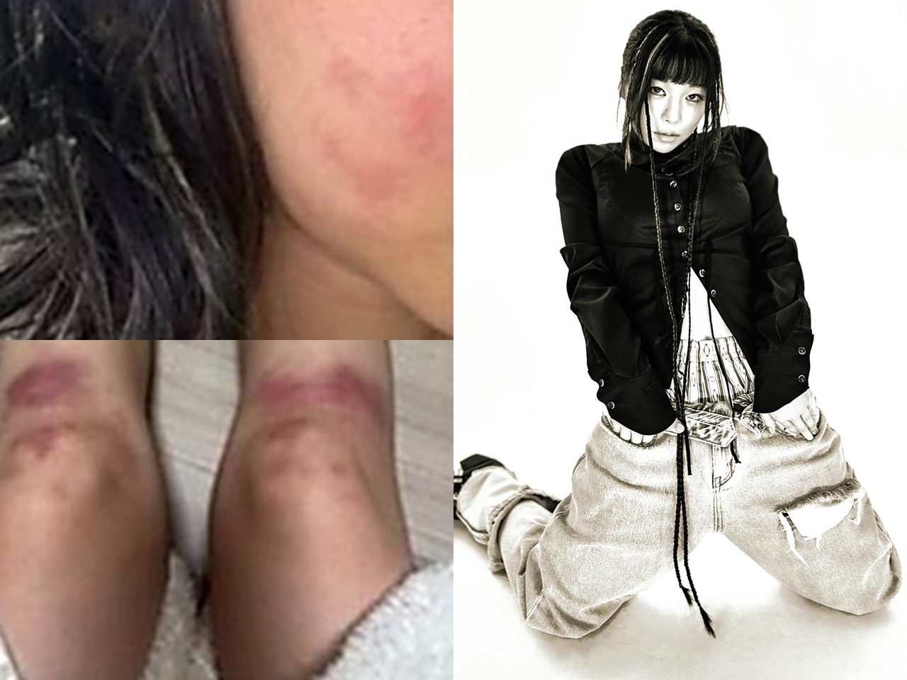 ボコボコに殴られた写真を投稿…交際していた男からのDV被害を主張した韓国女性ラッパー、所属事務所も支援へ